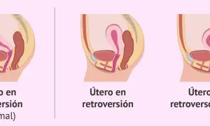 Ilustración comparativa de la posición del útero: anteversión (normal), útero en retroversión y útero en retroversoflexión.