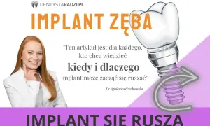Uśmiechnięta kobieta i grafika implantu zęba. Artykuł wyjaśnia, kiedy i dlaczego ruszający się implant zęba może być problemem.