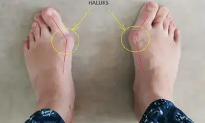 Do jakiego lekarza z haluksami? Ortopeda, podolog, fizjoterapeuta
