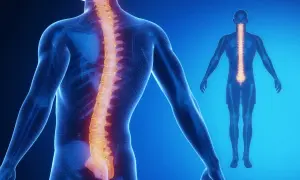 Schiena umana con colonna vertebrale evidenziata in arancione, mostrando curve che suggeriscono lordosi e scoliosi insieme.