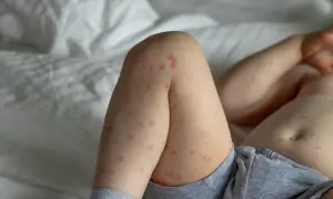 Piernas de un bebé con erupción cutánea roja, indicativo de roseola bebe.