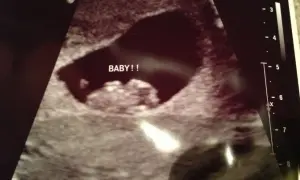 Ecografía temprana con la palabra "BABY!!" escrita. La posición del saco gestacional podría ser analizada con el método Ramzi.