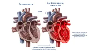 Objawy syndromu złamanego serca: Zawał czy takotsubo?