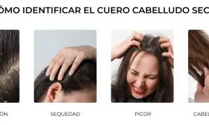 Cuatro imágenes muestran síntomas de cuero cabelludo seco: descamación, sequedad, picor y cabello sin brillo.