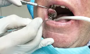 Dentysta wykonuje usuwanie korzenia zęba z ropą. Widoczne narzędzia stomatologiczne i lusterko.