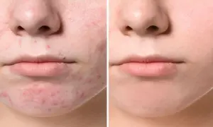 Confronto tra pelle con acne giovanile e pelle trattata, mostrando l'efficacia dei rimedi della nonna.