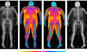 Radiographies et thermographies corporelles montrant une transformation : je m'affine mais je prends du poids. Les couleurs chaudes indiquent la graisse, les bleues les os.