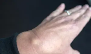 Ein kleiner, gelblicher Schleimbeutel am Handgelenk einer Person mit einem Ring.