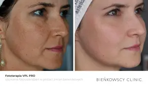 Przed i po fototerapii VPL PRO: widoczna redukcja przebarwień i plam na skórze twarzy.