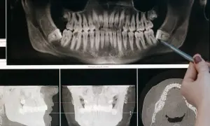 Radiographie dentaire montrant une dent de sagesse impactée, indiquant la nécessité d'une extraction.