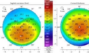 Dwie mapy topografii rogówki z kolorowymi skalami. Analiza topografii rogówki cena może być kluczowa dla wyboru metody leczenia.