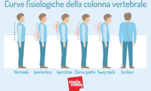 Illustrazione mostra posture della colonna vertebrale: normale, iperlordosi, ipercifosi, dorso piatto, sway back e scoliosi. La scoliosi sinistro-convessa può causare invalidità.