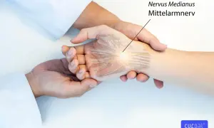 Ärzte prüfen das Hoffmann-Tinel-Zeichen am Handgelenk, um den Nervus medianus (Mittelarmnerv) zu untersuchen.