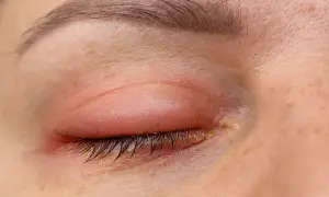 Ojos hinchados y enrojecidos, con secreción amarillenta en las pestañas. Parece que alguien lloró mucho o tiene una infección.
