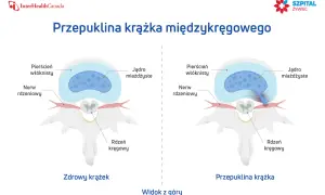 Porównanie zdrowego krążka międzykręgowego i przepukliny krążka. Widok z góry pokazuje ucisk na nerw rdzeniowy.