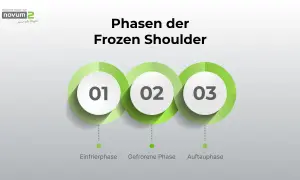 Phasen der Frozen Shoulder: Einfrier-, Gefrorene- und Auftauphase. Psychische Ursachen können die Heilung beeinflussen.