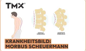 Vergleich einer normalen und gekrümmten Wirbelsäule, die das Krankheitsbild Morbus Scheuermann im Endstadium illustriert.