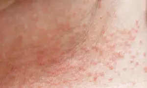 Haut mit kleinen roten Pickelchen, die auf einen Ausschlag vom Schwitzen hindeuten.