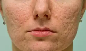 Pasta do zębów na pryszcze? Dermatolog radzi, co naprawdę działa!