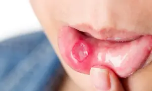 Dettaglio di una bocca con afte, una lesione dolorosa all'interno del labbro inferiore.