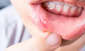 Nahaufnahme einer Lippe mit einem weißen, wunden Fleck. Ein Finger berührt die betroffene Stelle, die auf wunden im mund hausmittel hinweist.