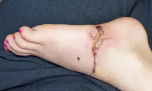 Stopa z raną pooperacyjną, która zaczyna wykazywać objawy gangreny. Widoczne są ciemne, martwicze tkanki i zaczerwienienie.
