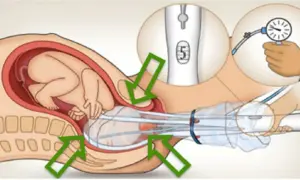 Illustration d'un bébé dans l'utérus, avec une ventouse d'accouchement appliquée sur sa tête. Un manomètre indique la pression.
