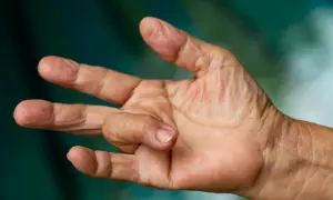 Nahaufnahme einer Hand, bei der ein Finger in einer gekrümmten Position verharrt. Dies kann ein Symptom für einen Schnappfinger sein, dessen Ursache oft eine Entzündung der Sehnenscheide ist.
