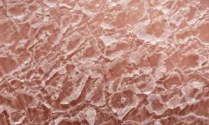 Jakie kosmetyki w czasie chemioterapii pomogą chronić wrażliwą skórę?