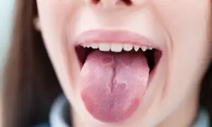 Otwarta buzia z widocznym, lekko zaczerwienionym językiem. Szukasz domowych sposobów na piekący język?