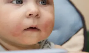 Czerwone, suche policzki dziecka mogą wskazywać na uczulenie na gluten. Twarz malucha jest zaczerwieniona wokół ust.