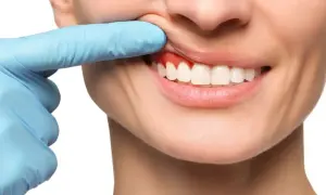 Ból zęba? Czerwone, opuchnięte dziąsła mogą wymagać antybiotyku na zęba. Dentysta bada dziąsła.