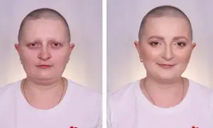 Czy po chemii wypadają brwi i rzęsy? Poznaj prawdę o skutkach terapii