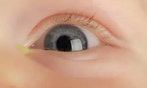 Niebieskie oko dziecka z zieloną ropą w kąciku.
