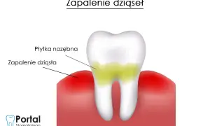 Co na dziąsła w ciąży? Skuteczne sposoby na zapalenie i ból