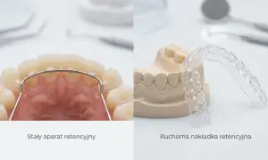 Dwa rodzaje aparatów retencyjnych: stały, widoczny na zębach, oraz ruchoma nakładka na gipsowym modelu.