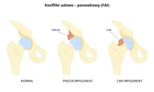 Ilustracja porównująca prawidłowe biodro z biodrem z konfliktem typu PINCER i CAM.