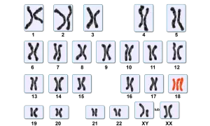 Kariotyp przedstawia pary chromosomów, w tym trzy chromosomy w parze 21, co może wskazywać na zespół Downa.