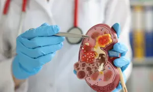 Lekarz w niebieskich rękawiczkach pokazuje model nerki z guzem, omawiając wynik egfr.