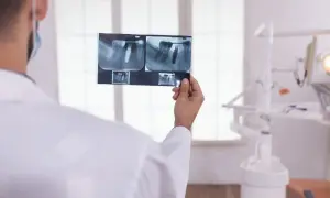 Dentysta analizuje RTG zęba z implantem. Zastanawia się, ile kanałów ma 6.