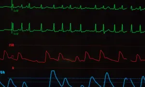 Monitor EKG pokazuje nieregularne fale, co może sugerować migotanie przedsionków. Długość życia z migotaniem przedsionków zależy od wielu czynników.
