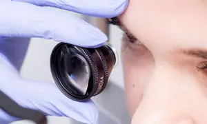 Rękawiczka z soczewką zbliża się do oka, przygotowując do laseroterapii siatkówki.