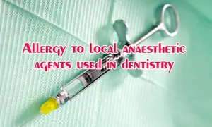 Objawy uczulenia na znieczulenie u dentysty – jak rozpoznać i zapobiec reakcji alergicznej