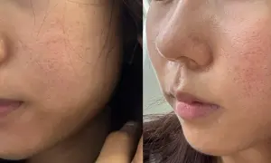 Split image showing a woman's cheek and nose area before and after fractional laser treatment, highlighting changes in skin texture and pore appearance.
