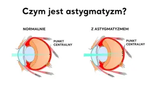 Astygmatyzm: Objawy, przyczyny i skuteczne metody korekcji