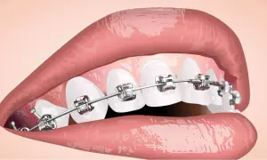 Denti con apparecchio metallico, parte di un percorso di cure ortodontiche per un sorriso perfetto.