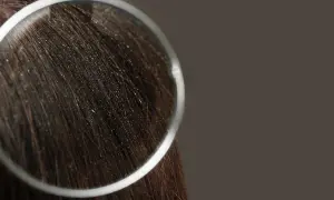 Capelli scuri con forfora visibile sotto lente d'ingrandimento. Scopri i migliori rimedi naturali per la forfora.