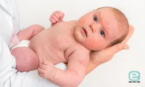 Niemowlę z czerwonymi plamkami na skórze, objawy uczulenia na nabiał.