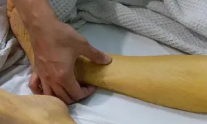Żółta skóra nogi, wskazująca na podwyższony poziom bilirubiny w moczu.