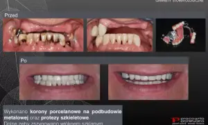 Szynowanie zębów: Na jak długo? Od urazu po paradontozę